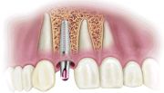 Что такое имплантация зубов